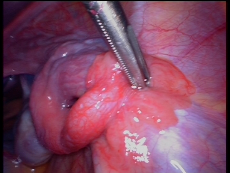 fimbrial-end-fallopian-tube-normal fimbrial-end-fallopian-tube-normal